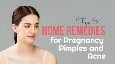 Top 6 Home Remedies for Pregnancy Pimples